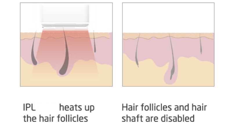 Устройства для удаления волос на теле